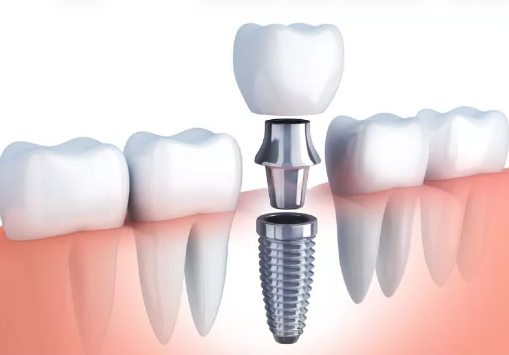 cosmetic-dental-implant