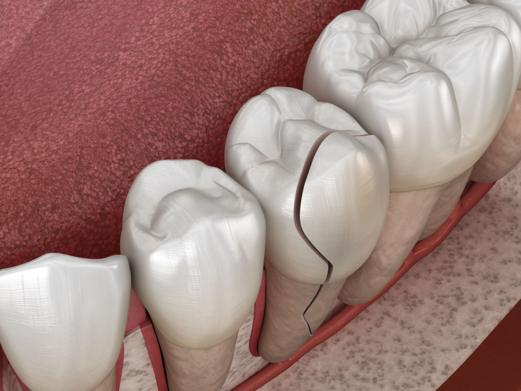 cracked-tooth-illustration