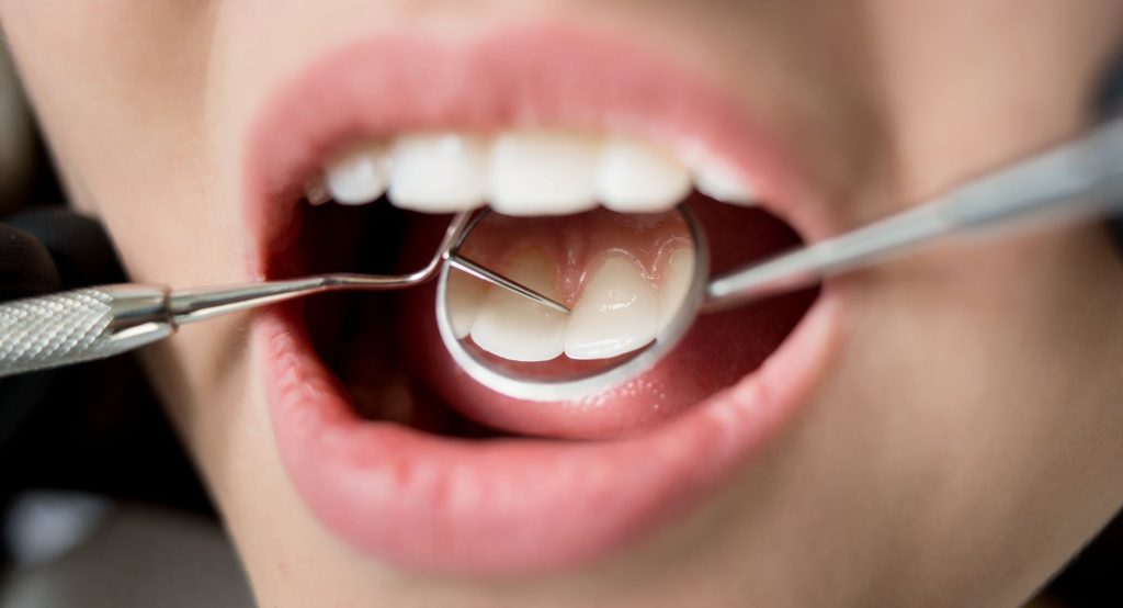 dental-bonding