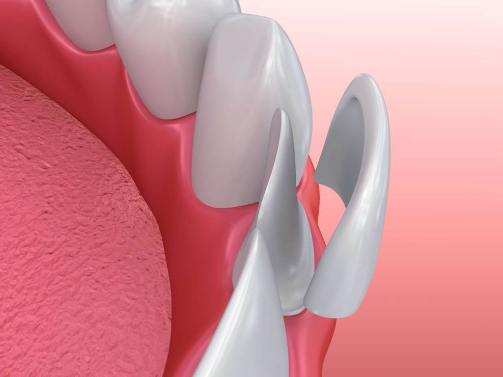 veneers
