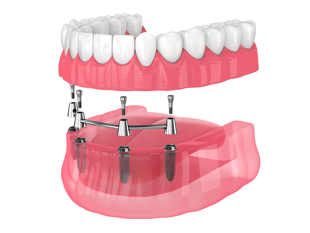 All-On-4-Dental-Implant-Service-Queens
