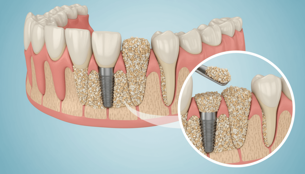 Bone-Graft-dentist-Queens