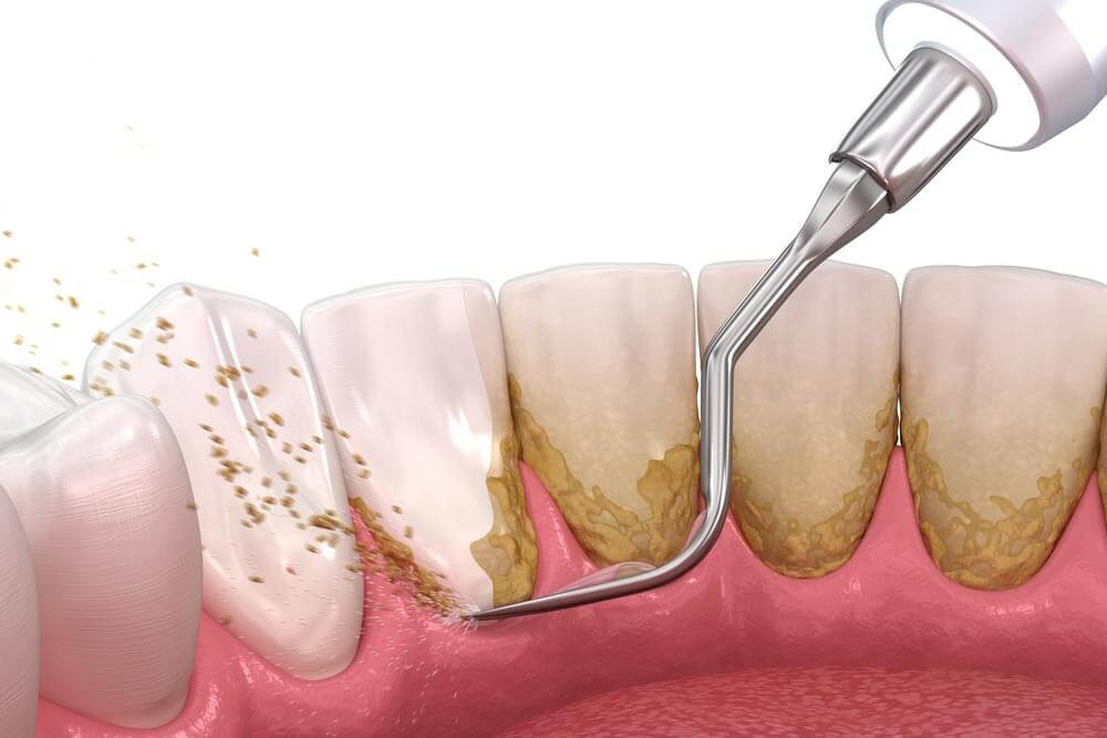 Periodontal-Therapy