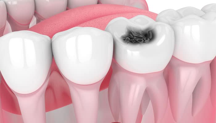 Tooth-decay-treatment-Queens