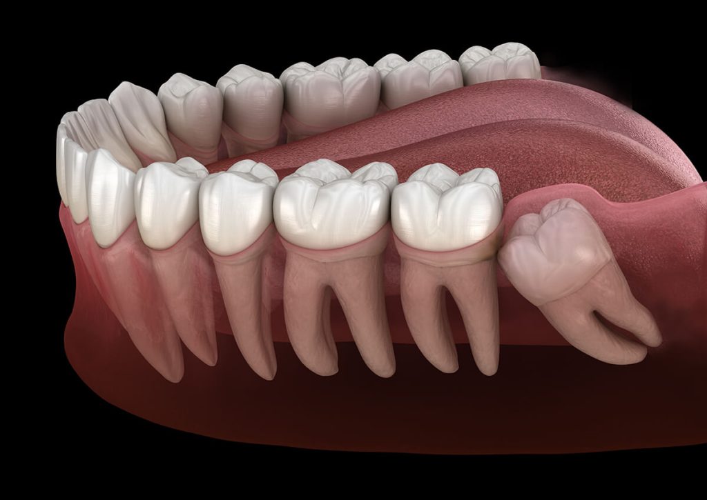 Wisdom-Teeth-Removal-Queens