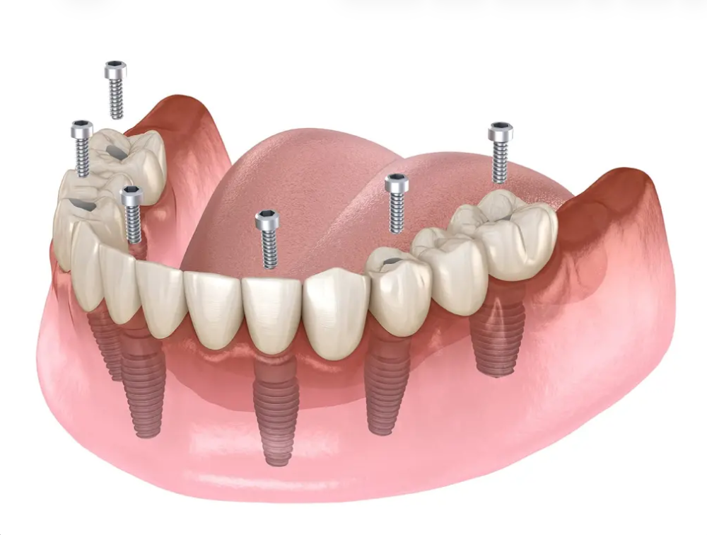 all-on-6-dental-implants-Queens