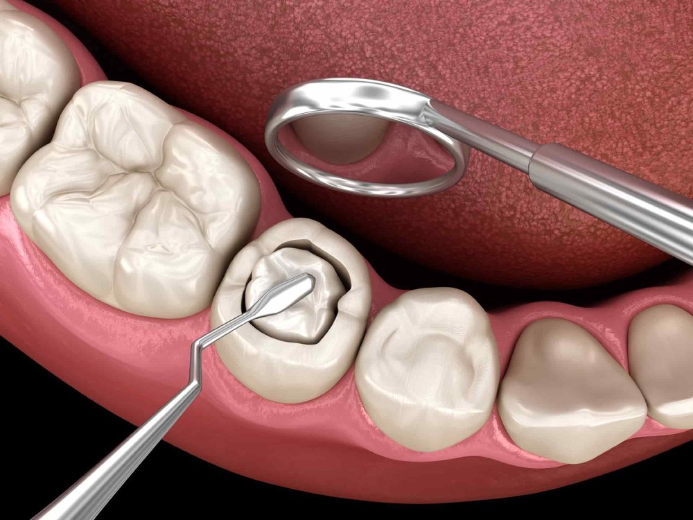 composite-fillings-dentist-Queens
