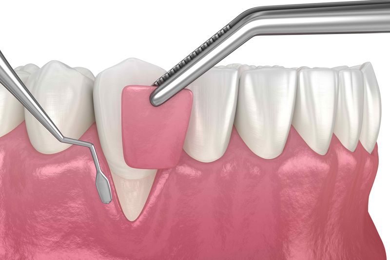 crown-lengthening