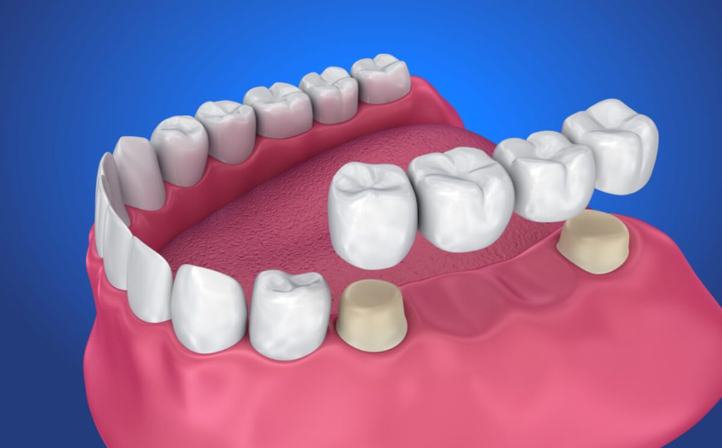 dental-bridges