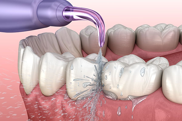 dental-cleaning-Queens