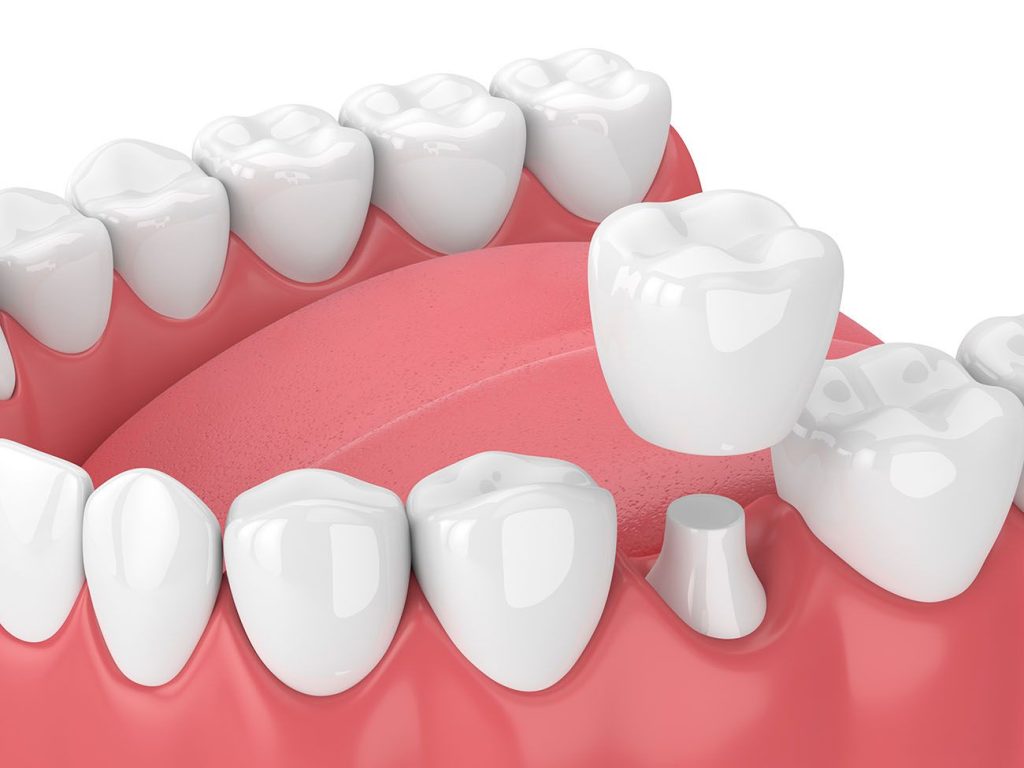 dental-crowns-dentist-Queens.jpeg