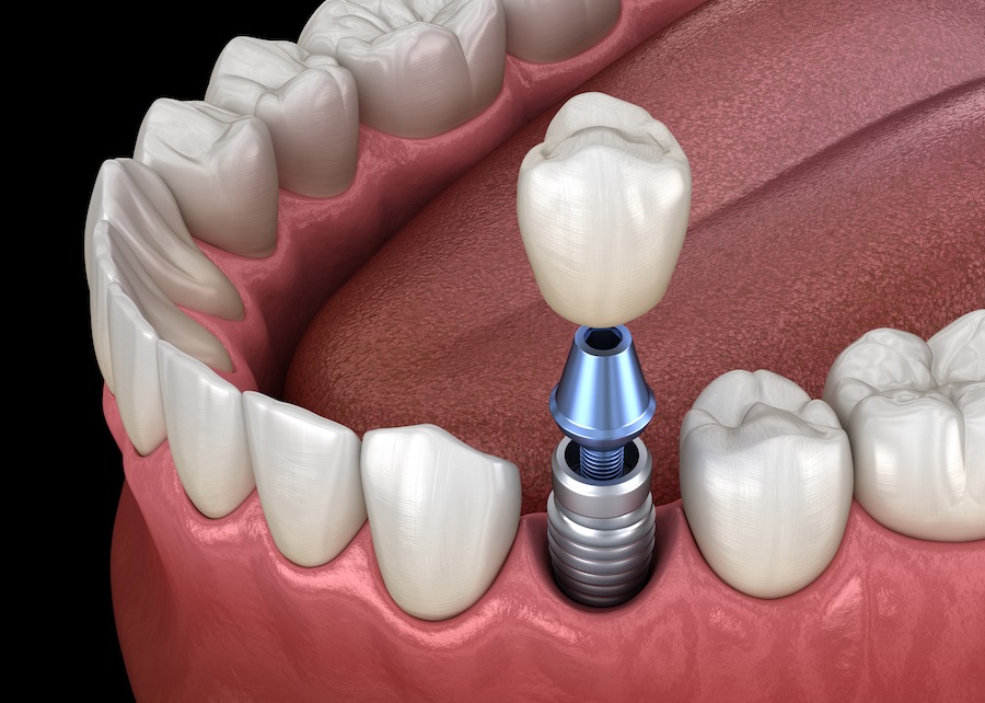 dental-implant-crown-repair