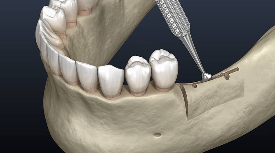 dental-ridge-augmentation