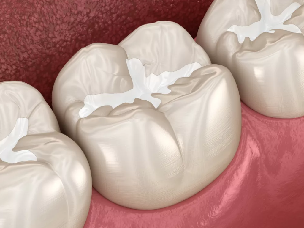 dental-sealants