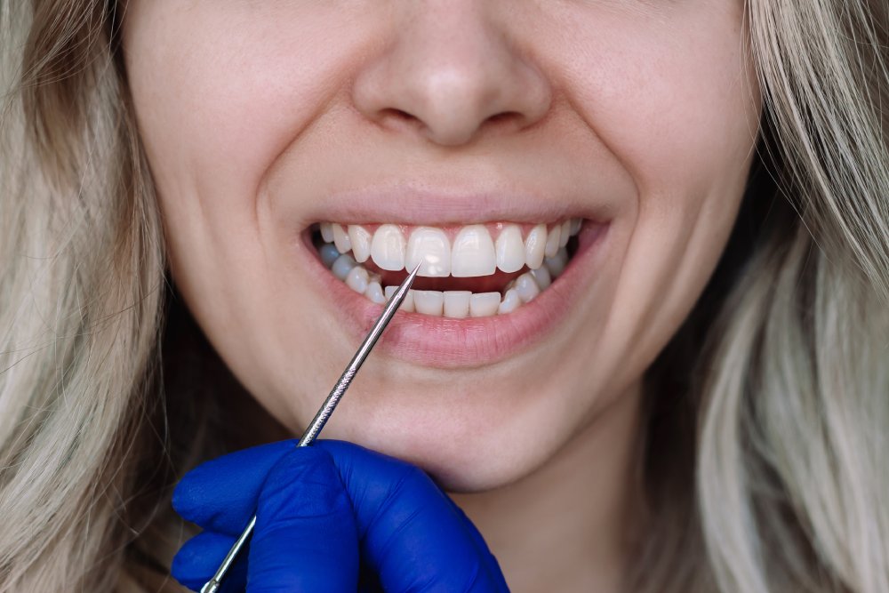 fluoride-treatment-Queens