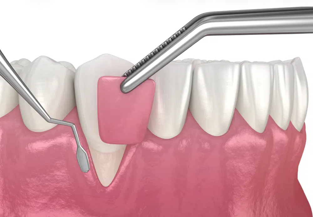 gum-disease-treatment