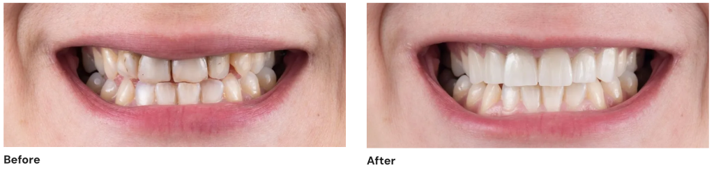 invisalign-dentist-queens