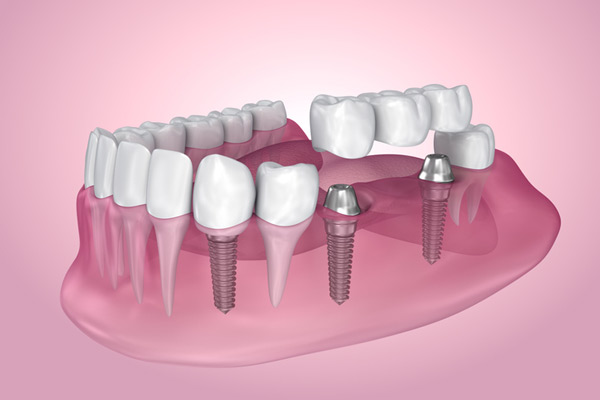 multiple-tooth-replacement