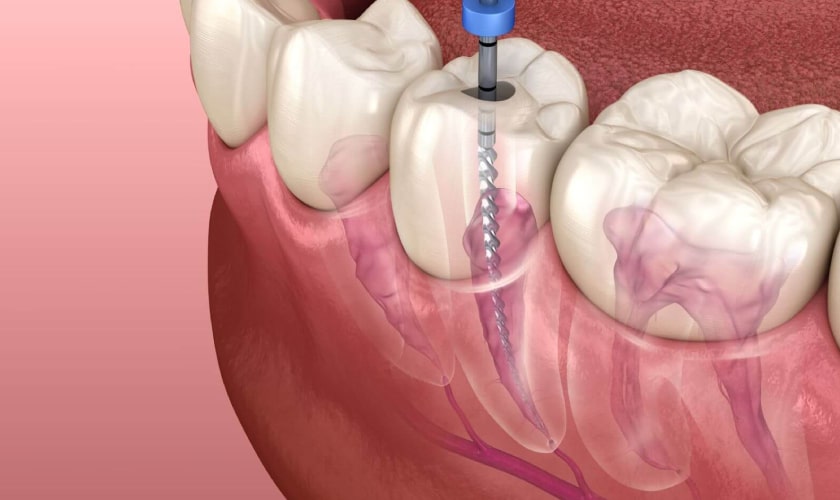 root-canal-treatment