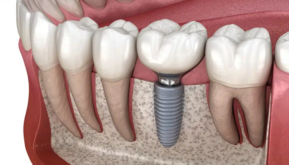 single-missing-tooth-treatment-Queens