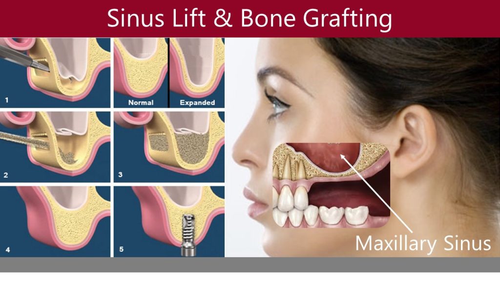 sinus-lift-in-Queens