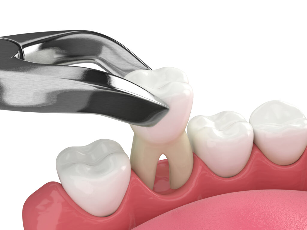 Tooth-Extraction-Dentist-Queens